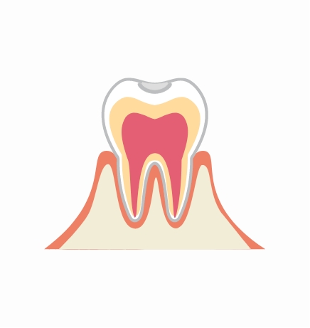 C1：初期むし歯（エナメル質の脱灰）