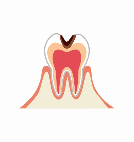 C3：重度のむし歯（象牙質の深部まで進行）