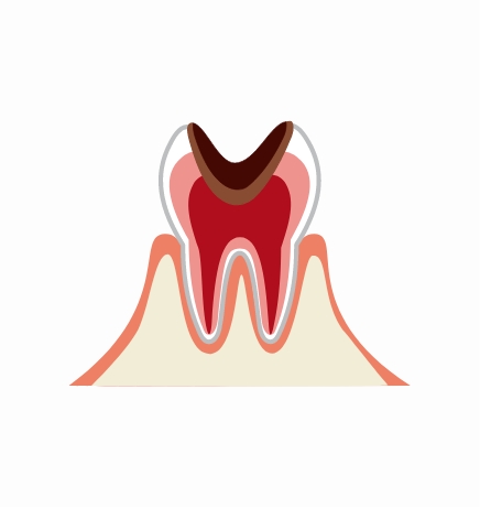C4：神経に達したむし歯（歯髄炎）