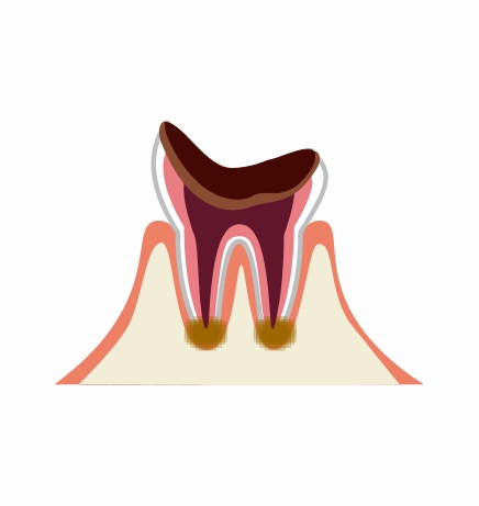 C5：歯冠崩壊・歯根まで進行したむし歯