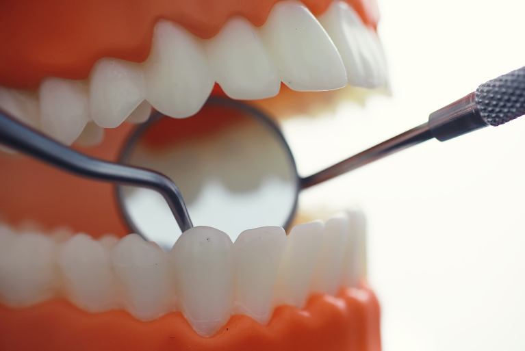 むし歯治療後も油断は禁物 ― 再発リスクと予防のポイント